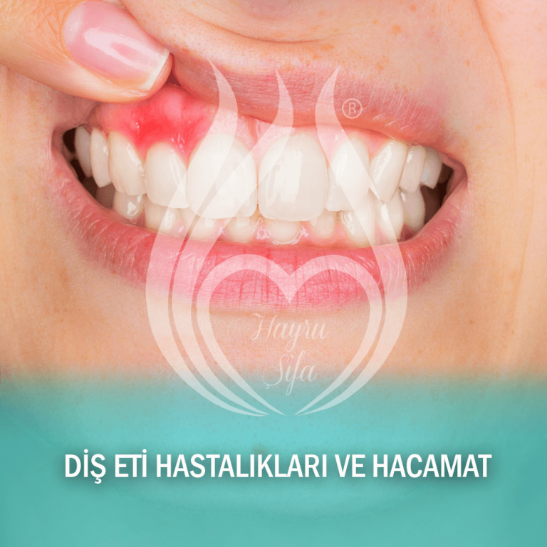 Diş Eti Hastalıkları Ve Hacamat Diş ve Dişi Eti Hastalıklarında Hacamat