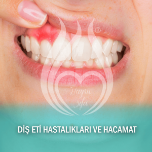 Diş Eti Hastalıkları Ve Hacamat