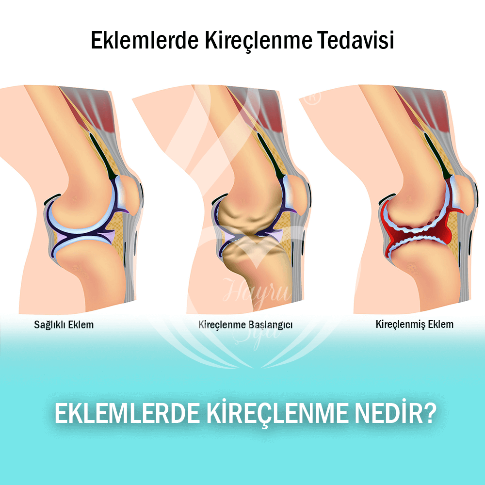 Eklemlerde Kireçlenme ve Tedavisi Nedir