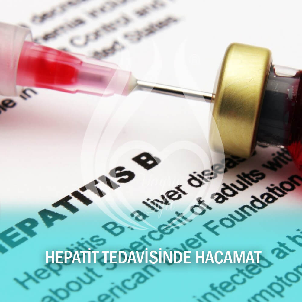 Hepatit Tedavisinde Hacamat Hepatit B ve Hacamat