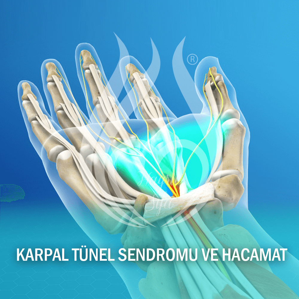 Karpal Tünel Sendromu ve Hacamat