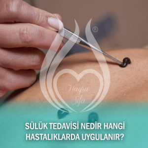 Sülük Tedavisi Nedir Hangi Hastalıklarda Uygulanır