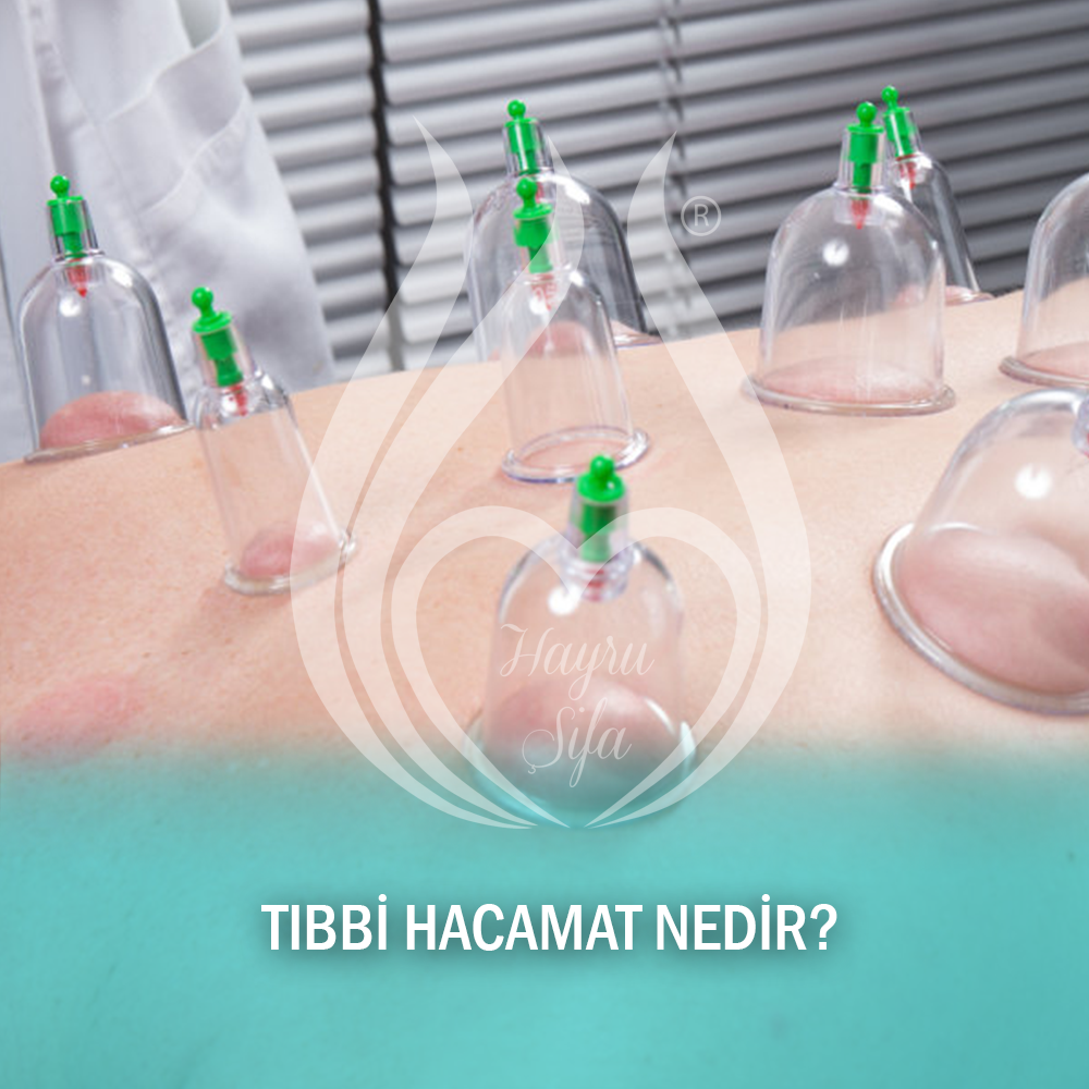 Tıbbi Hacamat Nedir?