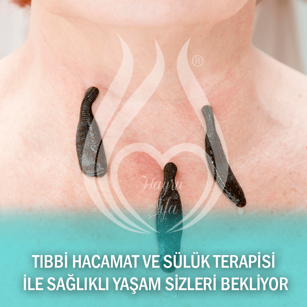 Tıbbi Hacamat ve Sülük Terapisi